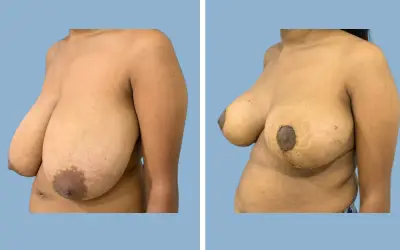 Before and After